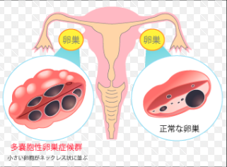 PCOS（多嚢胞性卵巣症候群）と診断されたあなたへ～漢方で整える体質改善の道～