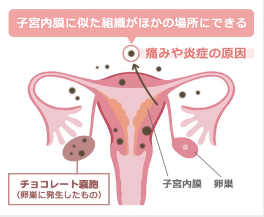 子宮内膜症でもあきらめない！――“めぐり”を整えて授かり体質へ